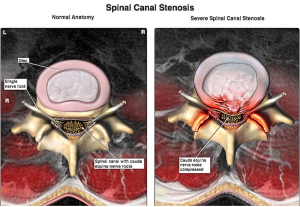 Spinal Canal Stenosis